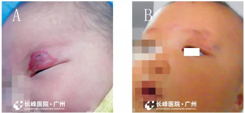 眼部血管瘤会变癌吗,眼睛血管瘤造成失明可以恢复吗