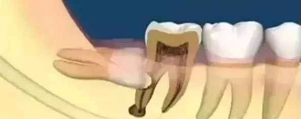 智齿拔除后怎么处理智齿,智齿有必要拔吗智齿痛怎么办