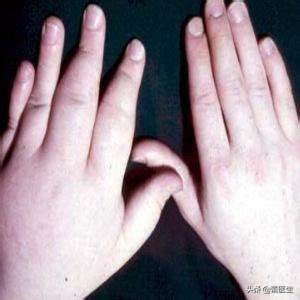 指甲银屑病治疗中会有哪些反应,指甲剥离症会疼吗