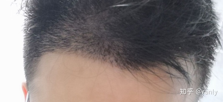 植发日记是什么,植发日记vlog第六天