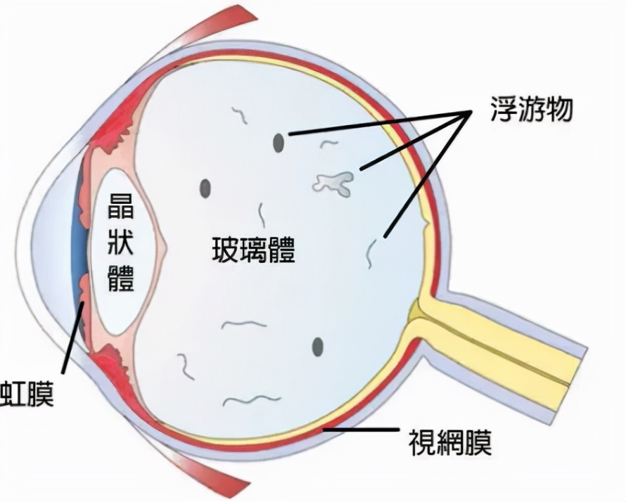 十三岁高度近视能做巩膜加固术吗,后巩膜加固术提高视力