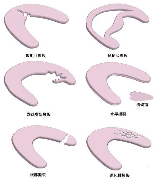 半月板撕裂要不要去修复,内侧半月板撕裂会切除多少半月板