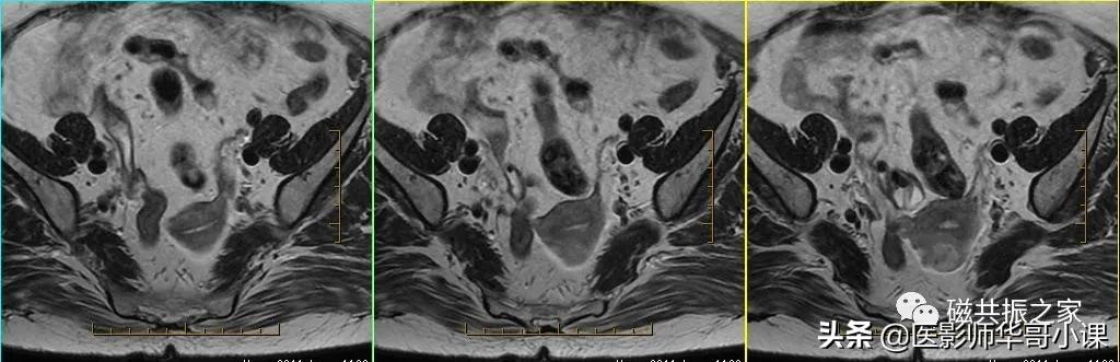 「精品课件」带大家看看，磁共振子宫MRI要如何扫描？