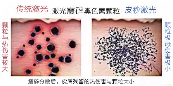 皮秒激光祛斑后怎么预防反黑,皮秒祛斑会反黑吗