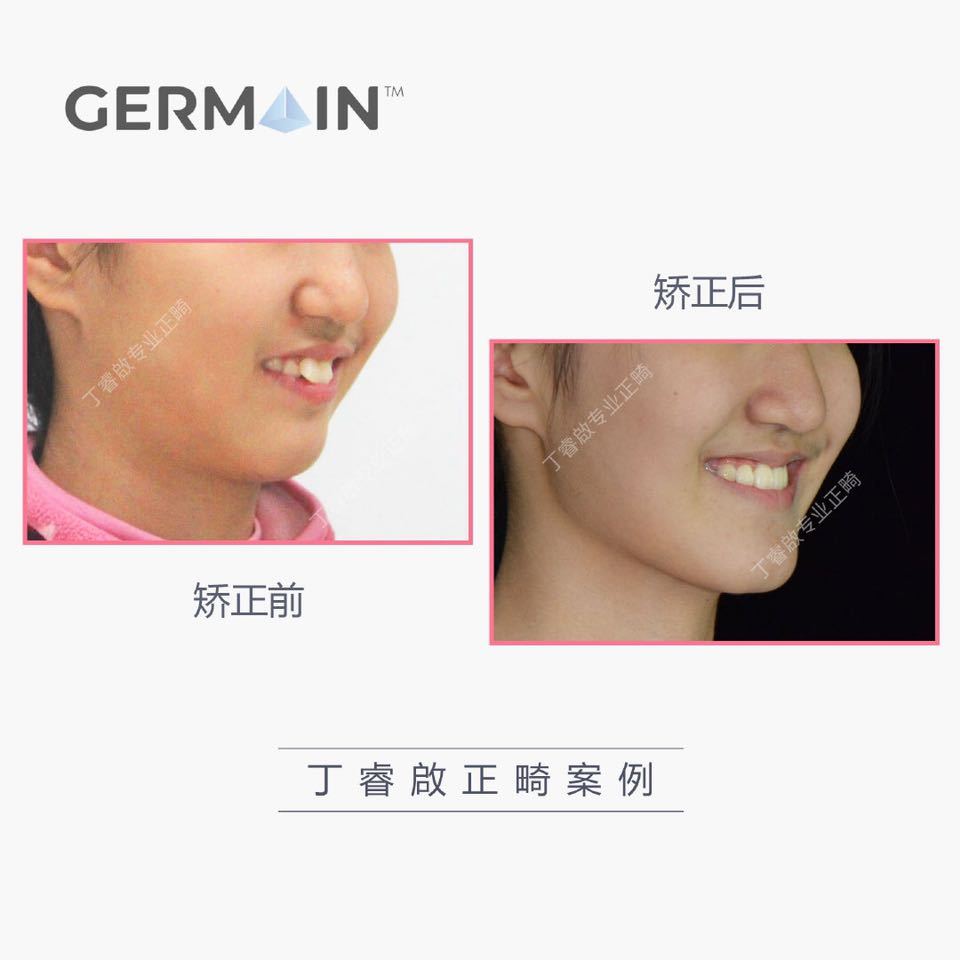 郑州牙齿矫正丁睿啟｜下巴后缩病例合集