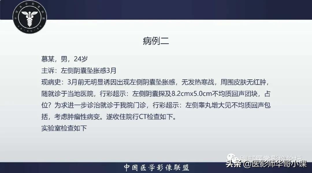 [精品课件]畸胎瘤及精原细胞瘤（*丸睾**肿瘤及肿瘤样变CT及MR表现）