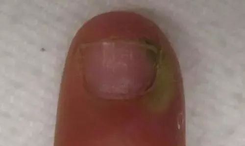 甲沟炎脚趾甲长到肉里,脚趾甲长到肉里很疼怎么处理