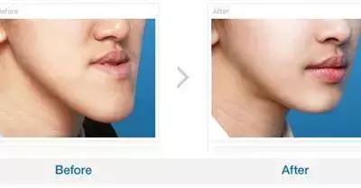 孩子地包天怎么治疗最有效,小孩地包天最佳治疗方法