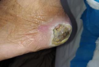 预防足跟压疮的正确方法,足跟压疮最佳治疗方法