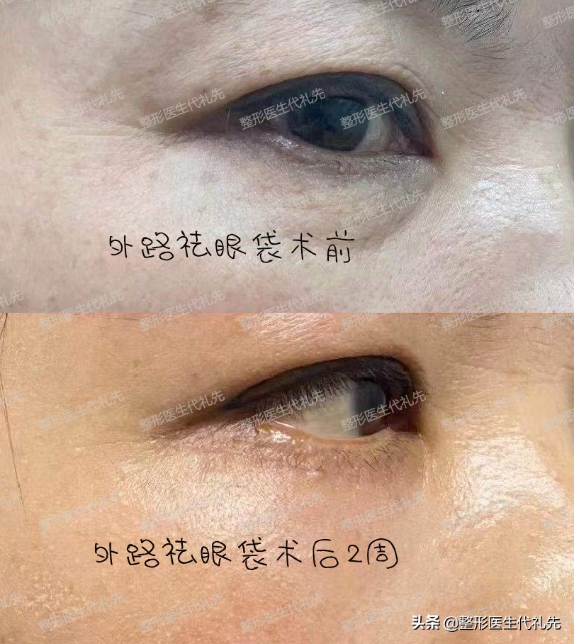 面部松弛提拉最好的方法,面部松弛下垂最好的提拉手术