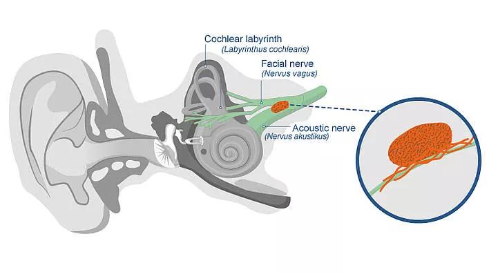 良性脑瘤一般能活多久,良性脑瘤没切干净要化疗