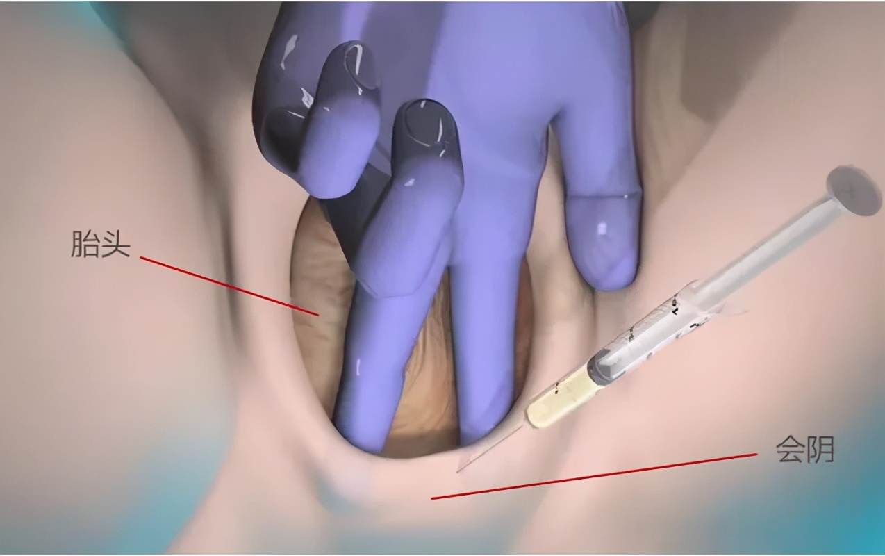 顺产侧切会不会留下后遗症?真相是?