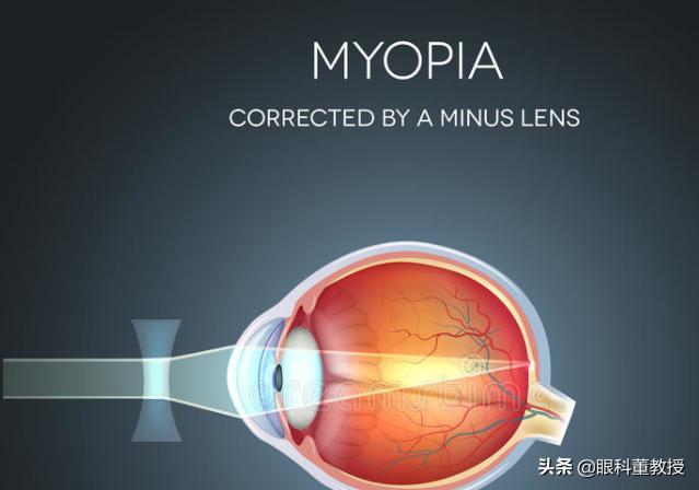 十二岁孩子单眼近视怎么治疗,单眼近视有什么小妙招可以恢复吗