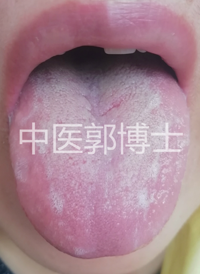 自汗加盗汗吃什么药,自汗四肢酸软吃啥药