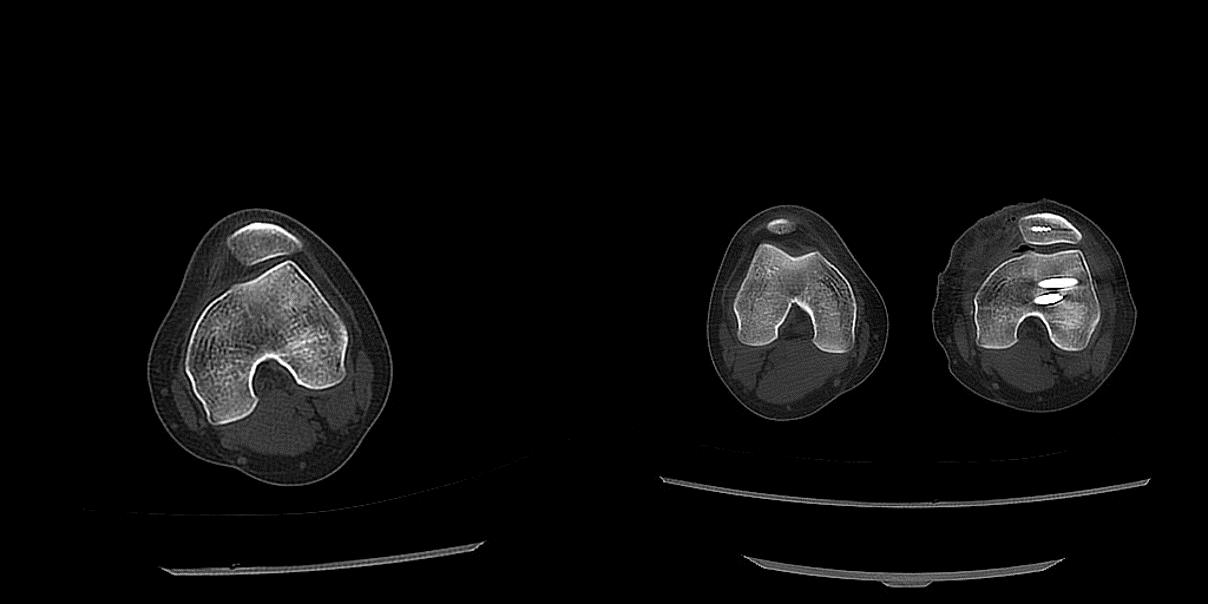膝盖髌骨脱位怎么处理,青少年膝盖半脱位能恢复吗