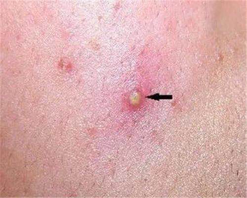 怎样祛痘痘最快最有效祛痘产品,如何祛痘并且不再长痘