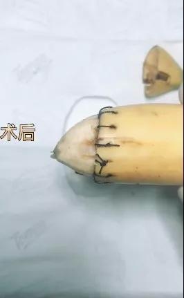 香蕉割包皮,洋葱剖腹产?这是我见过最秀的医生