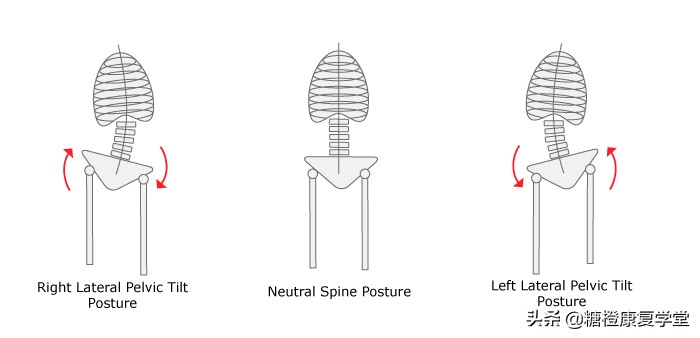 骨盆倾斜与脊柱侧弯还有这种联系？（1）
