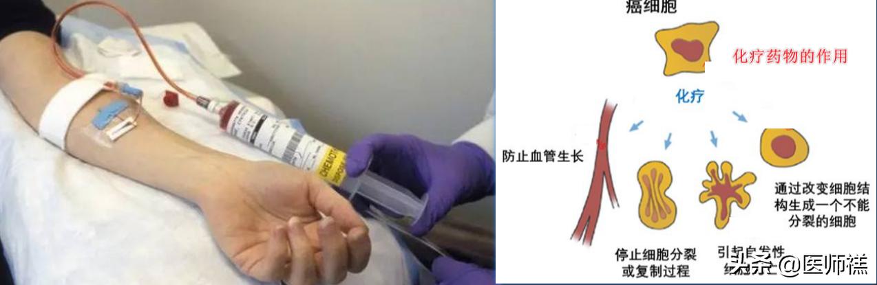 化疗呕吐处方药,化疗药物引起的恶心呕吐的科普