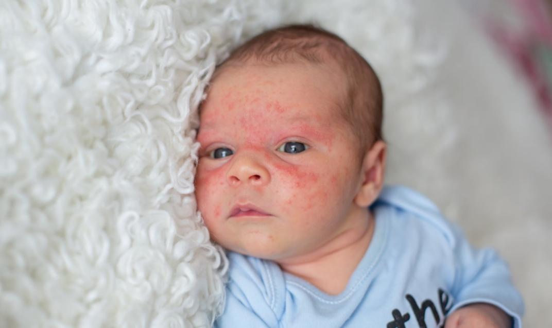 宝宝皮肤常见问题汇总:原因与对策妈妈要知道,孩子成长更健康