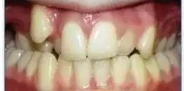 矫正牙齿可以改善凸嘴吗,凸嘴做正颌手术还是矫正牙齿好呢