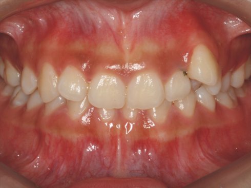 牙齿矫正有一颗倒了,牙齿矫正后又歪了谁负责