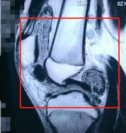 60-70岁膝盖滑膜炎最佳治疗方法,10个膝盖痛9个滑膜炎