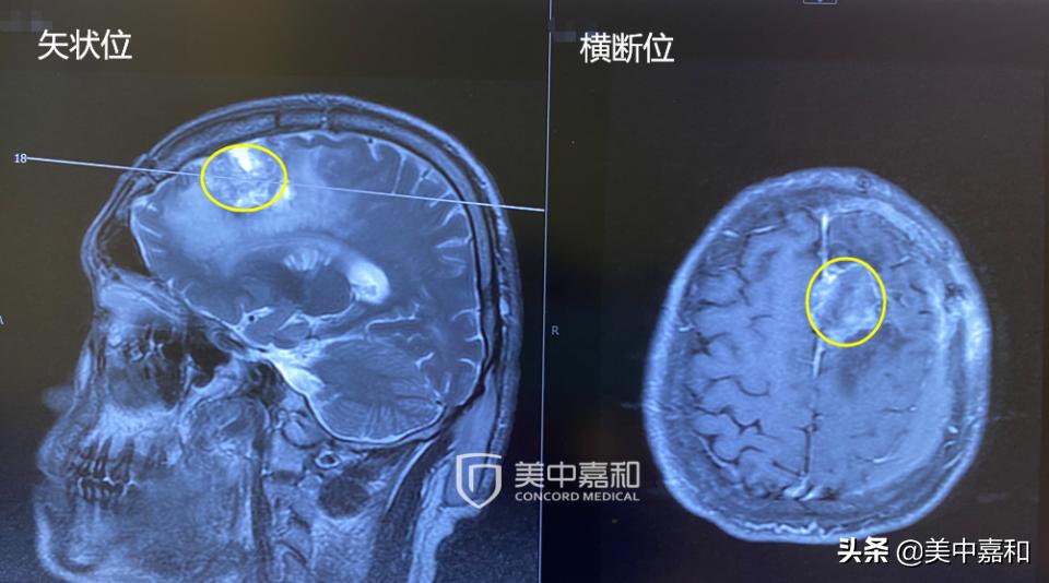 原始癌早期做手术后的注意事项,得癌后如何抵抗