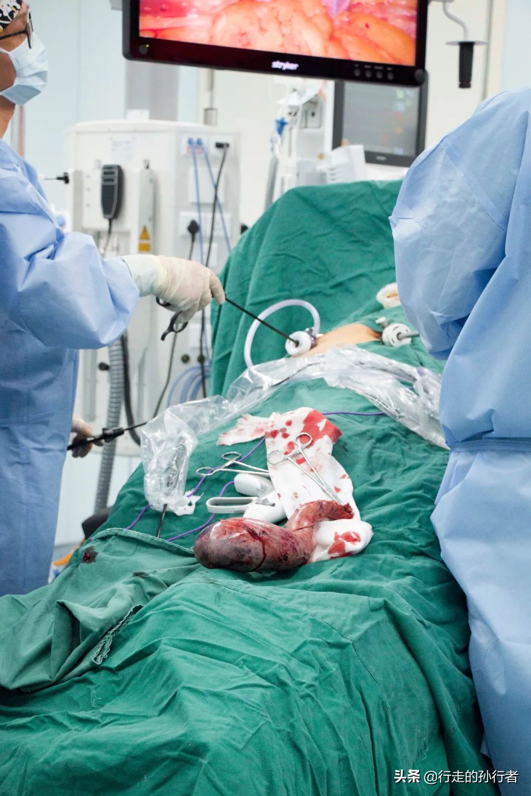 切胃减肥手术的副作用,为了减肥切胃到底值不值