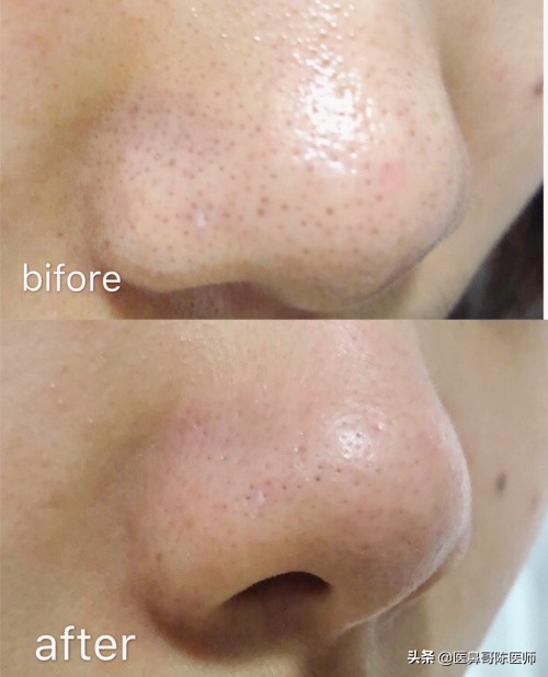 中医除黑头,手法去黑头好吗