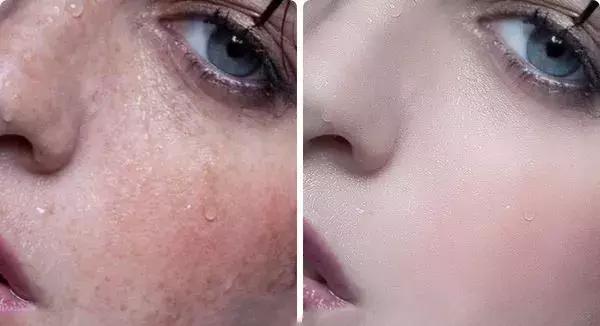 痘印祛痘药膏,痘印去除护肤品