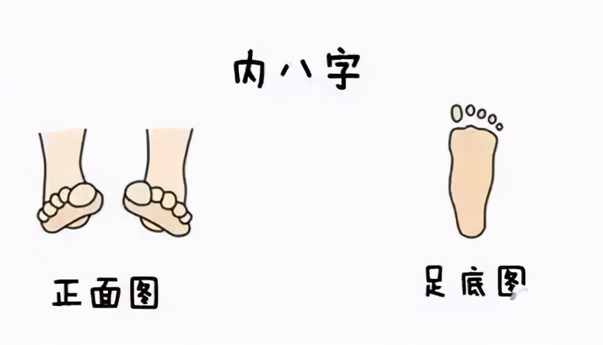 孩子一只脚内八字怎么纠正,小朋友内八字走路不稳怎么解决