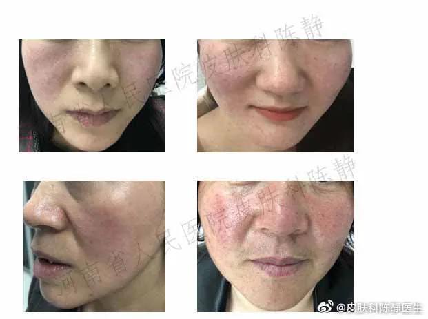 鼻头发红是日光性皮炎还是酒渣鼻,鼻头隐约有点红