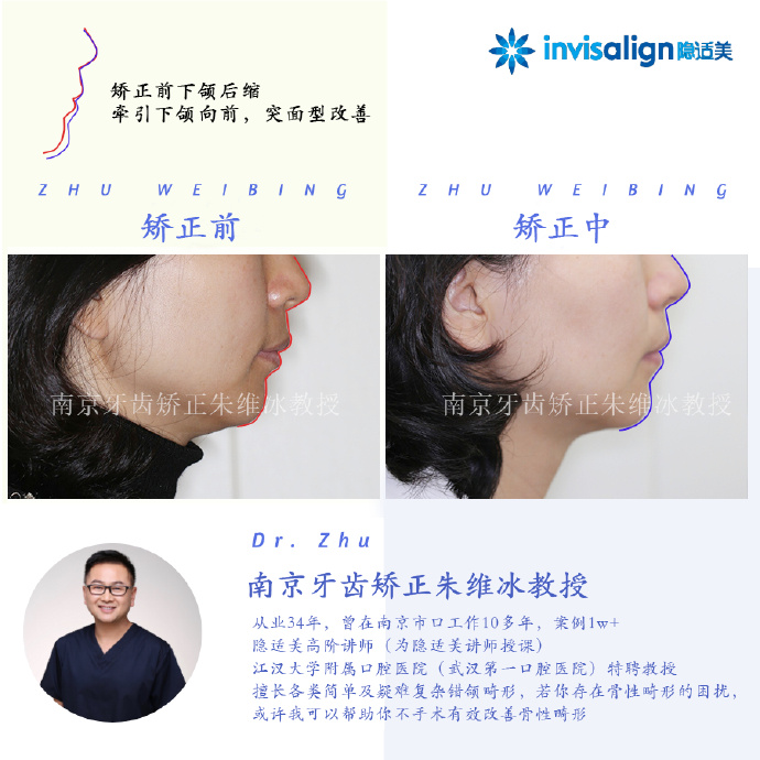 南京牙齿矫正:上颌骨性前突+下颌后缩+严重深覆合+牙齿拥挤