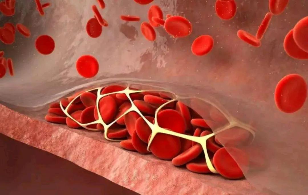 动脉斑块已形成是动脉硬化吗,动脉斑块钙化是好是坏