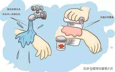 如果被烧伤烫伤最有效的应急办法,烧伤烫伤时应采取哪些措施