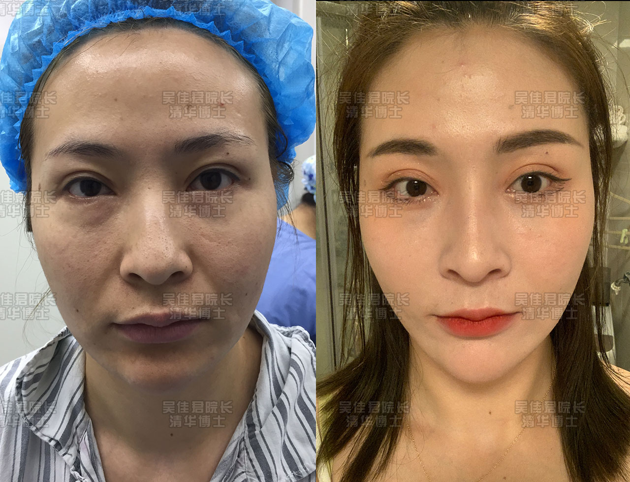 小拉皮手术后真实感受,小拉皮手术后的真实案例