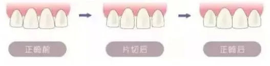 矫正拔牙全过程真实记录,拔牙后悔了不想矫正了怎么补救