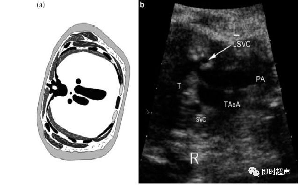 胎儿心脏三种血管关系模式图,25周的胎儿心脏弓切面多少正常