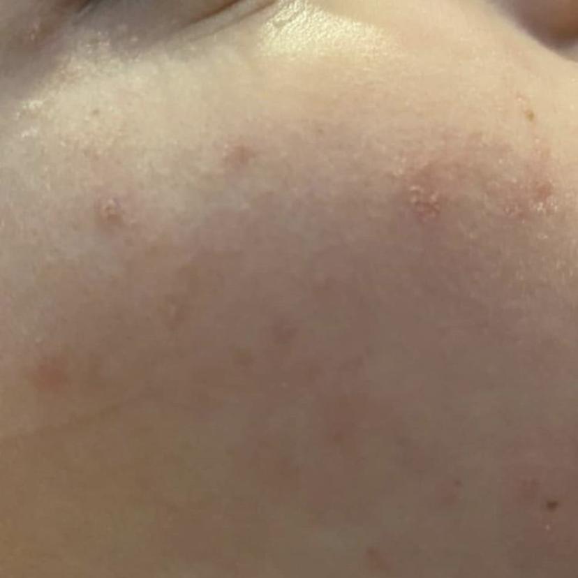 十年战痘肌自救指南,十年痘肌怎么抗痘