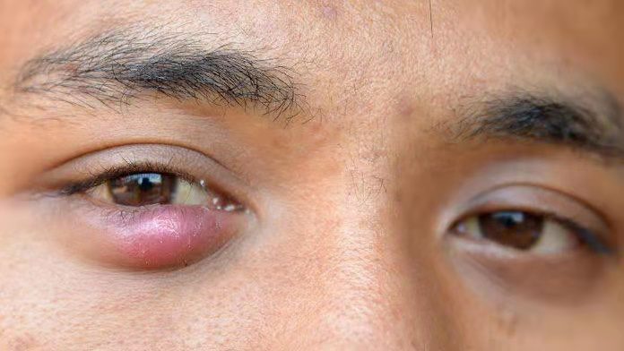 眼睑里有个红色的肿物,眼睑肿瘤的鉴别诊断单图片