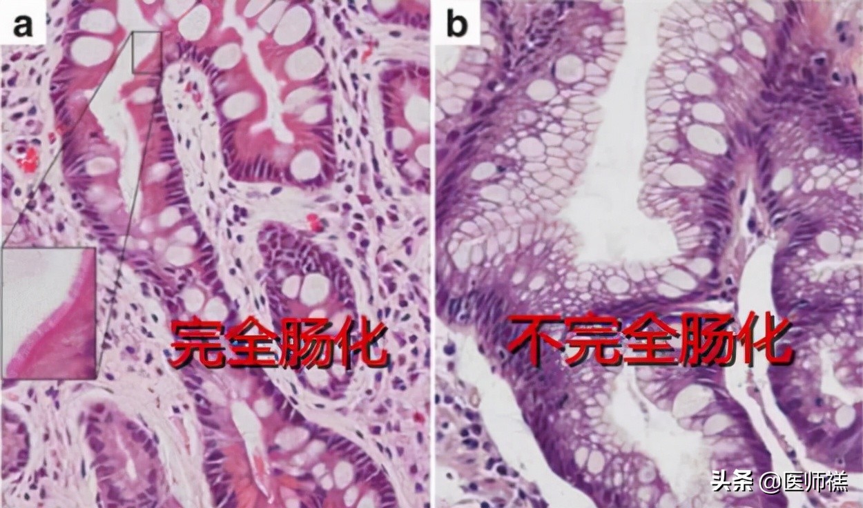 胃炎迁延不愈,胃炎久治不愈需要再做胃镜吗