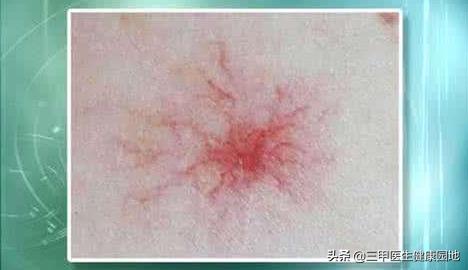 肝癌就医挂什么科,肝癌早期身体会出现3个提示