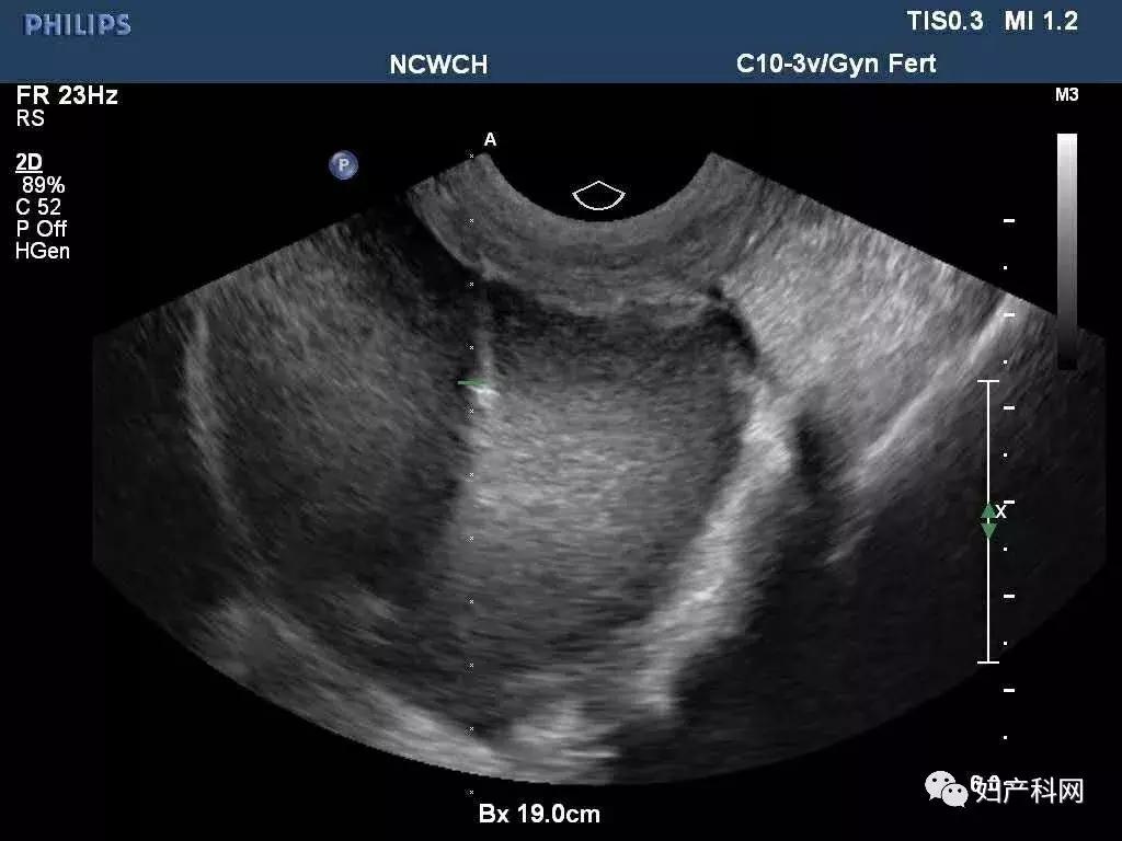 微·无创|NO.22病例分享之经阴道卵巢囊肿穿刺