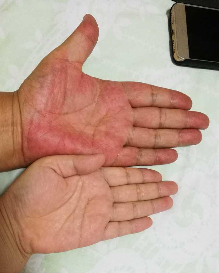 血脂高不高看这4个部位就知道,血脂偏高的4个信号