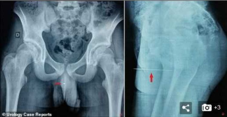 14岁男生把9厘米缝衣针插入尿道,痛苦三天去就医,网友:爽吗?