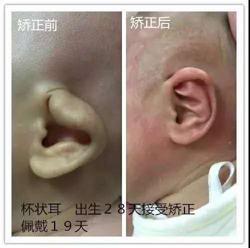 耳廓畸形高考生体检怎么办,二度耳廓畸形矫正方案