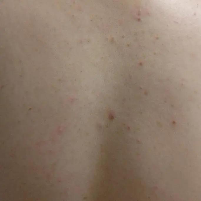 前胸后背的痘痘去不掉怎么办,前胸后背胳膊反复长痘痘该怎么办