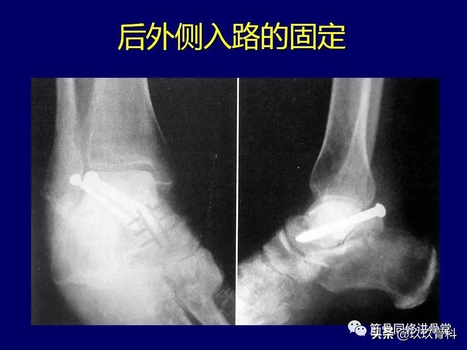 距骨骨折的治疗原则,距骨骨折如何调理