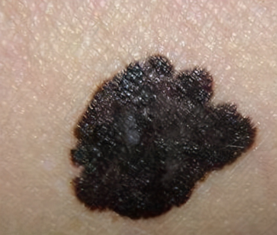 身上小肉球怎么治疗能根除,皮肤上有小肉球怎么处理